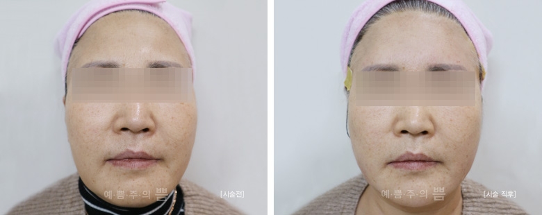 홍대점_원더풀리프팅 + 이마큐오필